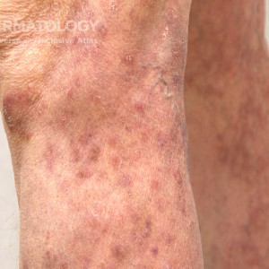 Tinea_Corporis_A_2.jpg