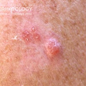 amelanotic_melanoma_B_60931.jpg