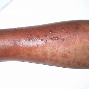 Leukocytoclastic Vasculitis_type D.jpg