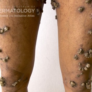 Keratosis Lichenoides Chronica_D_legs2.jpg