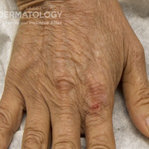 Dermatomyositis_B_Carrington13.jpg