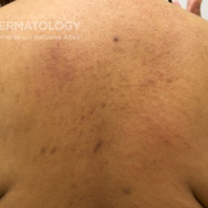 ContactDermatitis_D_Adusumilli_Back.jpg