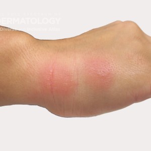 erythema hand type C_.jpg