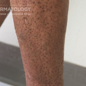 Cutaneous_Amyloid_D_Leg_2.jpg