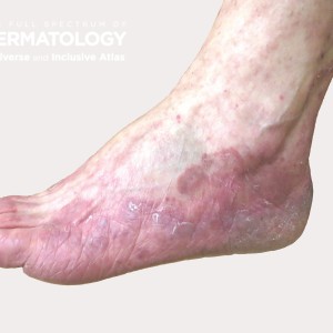 tinea pedis type A_Fullfoot_Friedman_.jpg