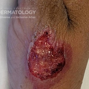 Acute Febrile Neutrophilic Dermatosis_DIR 61473.jpg