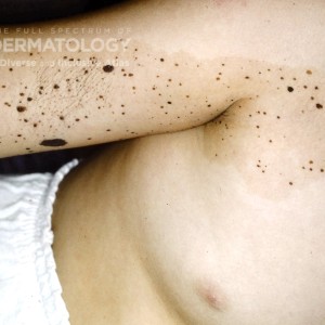 Nevus_Spilus_B_Trunk_Cohen.jpg