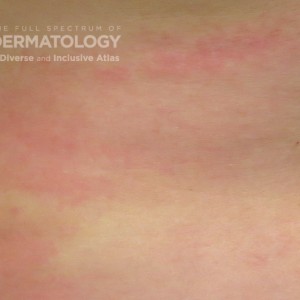 erythema type c_trunk_2.jpg