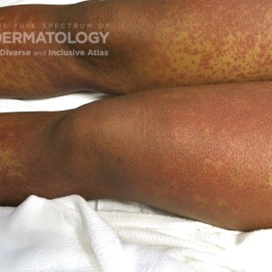 Leukocytoclastic Vasculitis type E legs.jpg