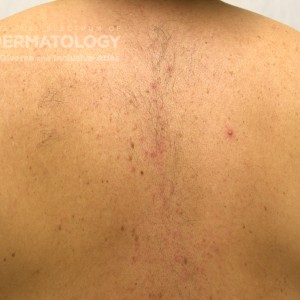 Folliculitis_B_Back_2.jpg