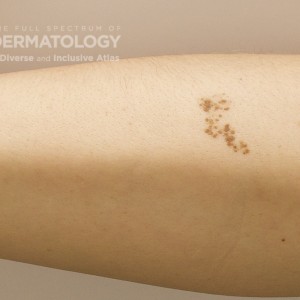 Nevus Spillus_FullForearm_A.jpg