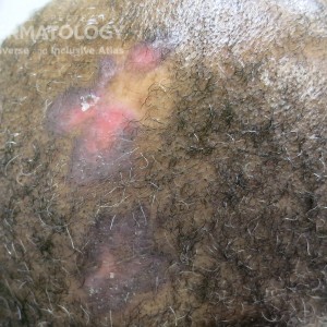 Discoid_Lupus_Erythematosus type E scalp.jpg