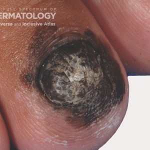 Melanoma, Acral,   (20050802170422046) 20050802170551906_.jpg