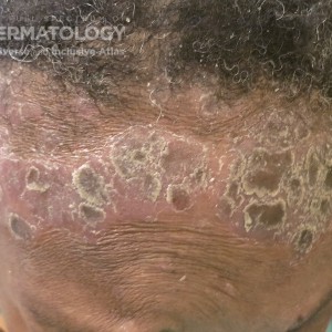 psoriasis scalp D.jpg