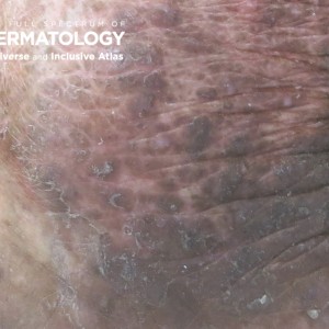 tinea incognito in setting of eczema_closeup_.jpg