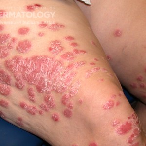 psoriasis RD.jpg