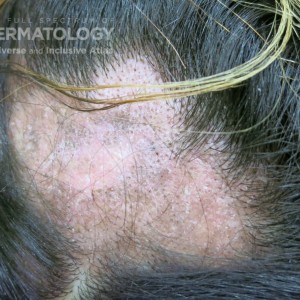 Discoid_Lupus_Erythematosus type C scalp.jpg