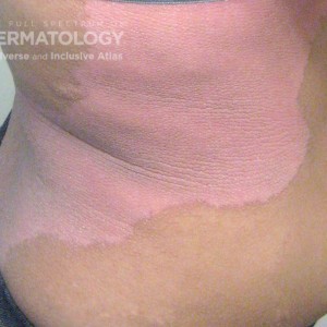 Pityriasis rubra pilaris 2_trunkFriedman.jpg