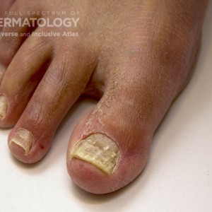 Onychomycosis_C_Foot4.jpg