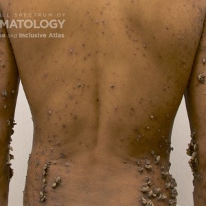 Keratosis Lichenoides Chronica_C_back8.jpg