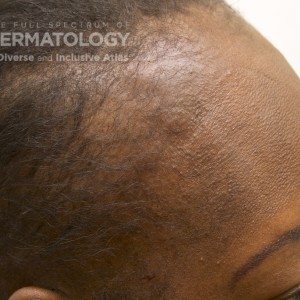 TractionAlopecia_E_ProfileHairline_7.jpg