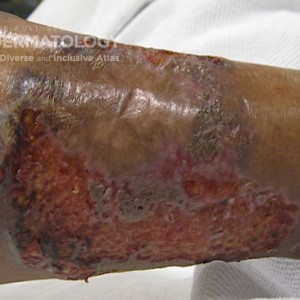 Pyoderma gangrenosum_c_Ortega.jpg