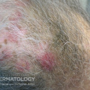 Discoid_Lupus_Erythematosus_scalp type d.jpg