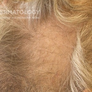 Alopecia Areata_D_Scalp_Side.jpg