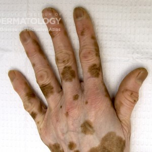 vitiligo_e_hands_closeup2.jpg