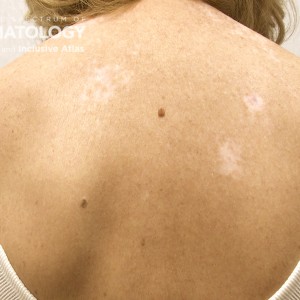 Vitiligo_B_Back_5.jpg