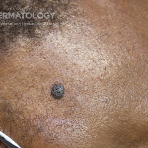 Seborrheic_Keratosis_D_Profile.jpg