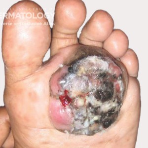 Acral_Melanoma_ 60316_.jpg