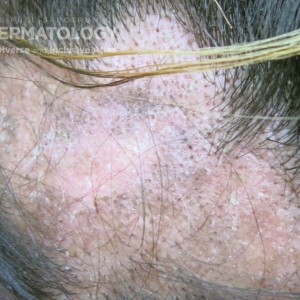 Discoid_Lupus_Erythematosus type C scalp_closeup.jpg