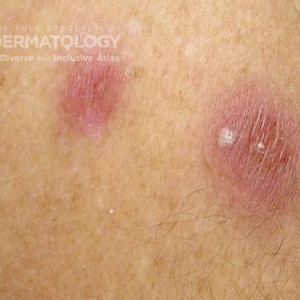 Acute Febrile Neutrophilic Dermatosis_ DIR60142.jpg