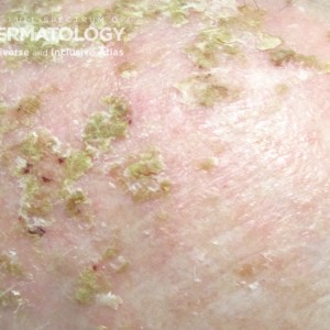 Actinic_Keratosis_1__A_JDD.jpg