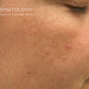 Melasma_B_ACheek5.jpg