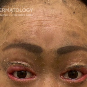 Icthyosis_C_facial_closeup.jpg