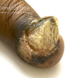 Squamous_Cell_Carcinoma_E_Nail_Closeup.jpg