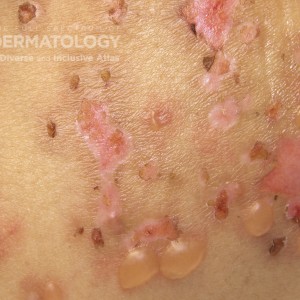 BullousPemphigoid_C_Adusumilli7.jpg