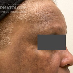 Melasma_Forehead_D_4.jpg