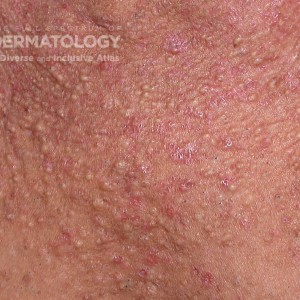 Keratosis follicularis_C_Chest.jpg