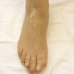 Vitiligo_B2_Foot_2.jpg