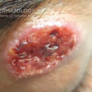 Leishmaniasis_B_61024.jpg