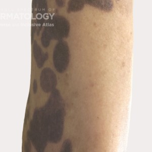 hyperpigmentation lower_arm type D.jpg