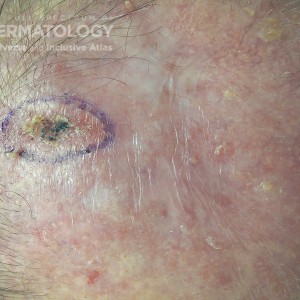 Actinic_Keratosis_2_JDD.jpg