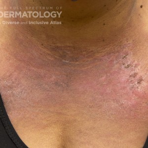 Dermatomyositis_D_Adusumilli_Chest.jpg