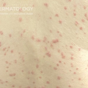 Pityriasis Rosea_Back_JDD.jpg