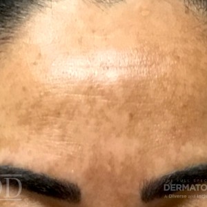 JDD M6663 Figure 4 Melasma 21_4_1