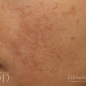 JDD M6491 Figure 1 melasma 21_12