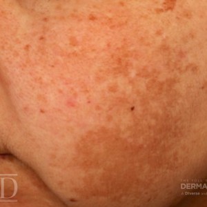 JDD M7340 Figure 3 baseline hyperpigmentation 22_4